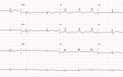 Dr Dave Richley ECG of the Month – April 2021