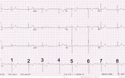Dr Dave Richley ECG of the Month – May 2021