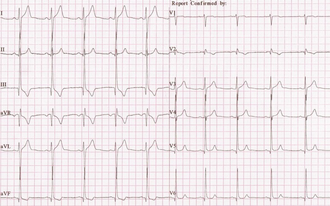 Dr Dave Richley ECG of the Month – June 2021