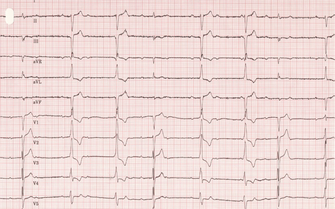 Dr Dave Richley ECG of the Month – July 2021