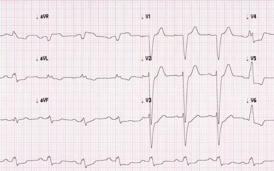 Dr Dave Richley ECG of the Month – August 2021