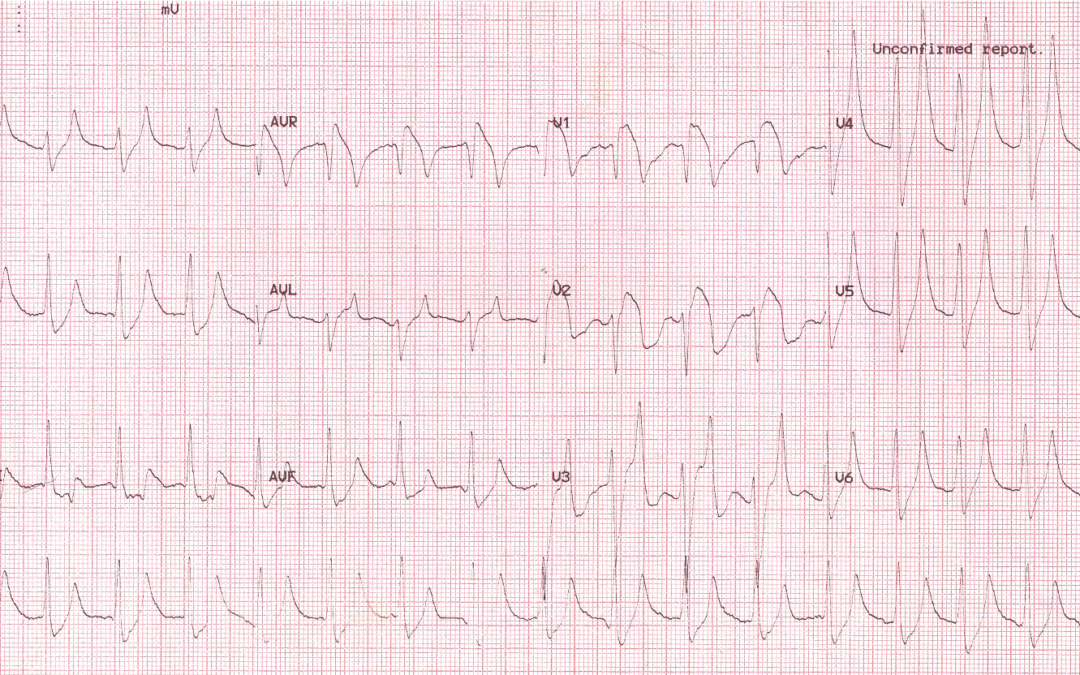 Dr Dave Richley ECG of the Month – November 2021