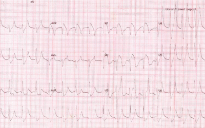 Dr Dave Richley ECG of the Month – November 2021