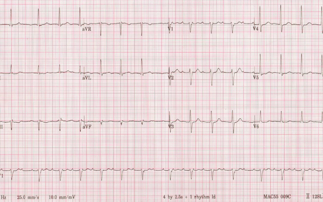 Dr Dave Richley ECG of the Month – December 2021