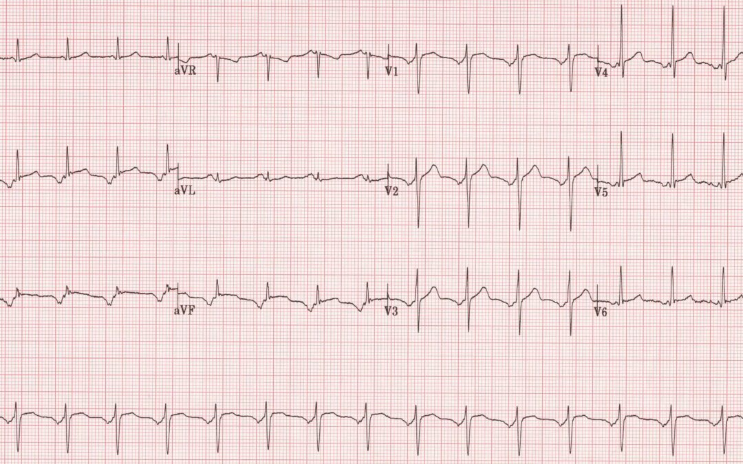 Dr Dave Richley ECG of the Month – January 2022