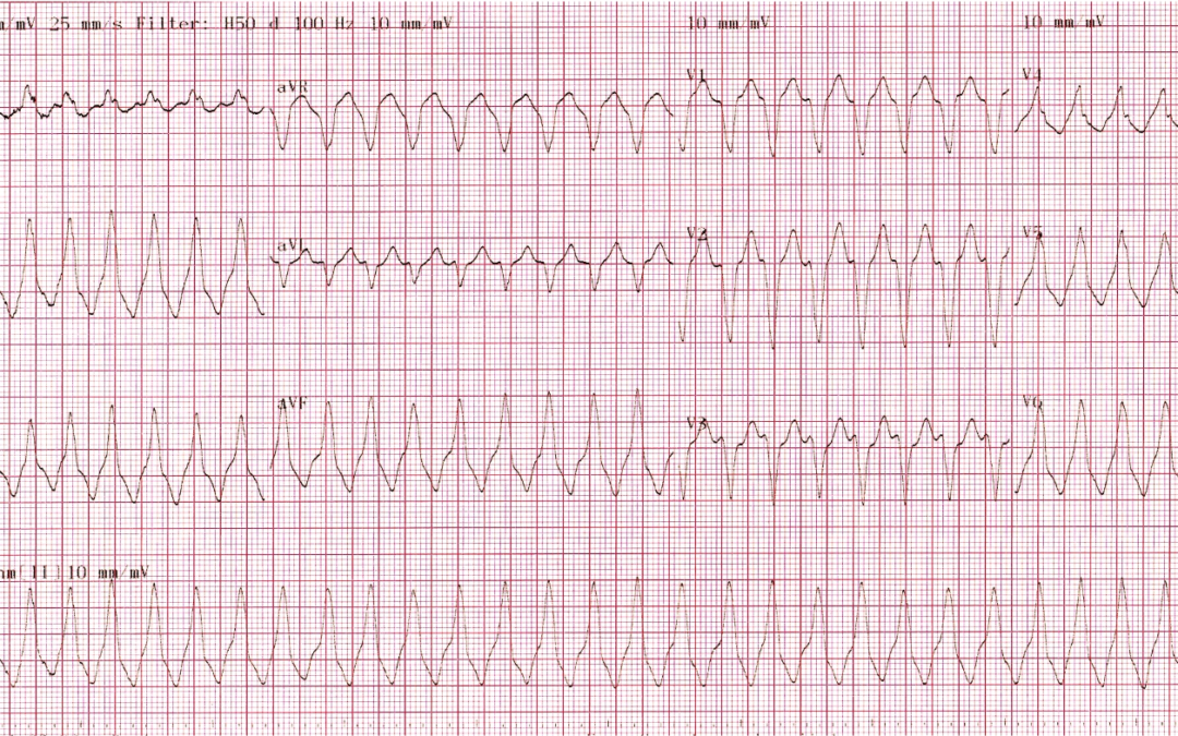Dr Dave Richley ECG of the Month – February 2022
