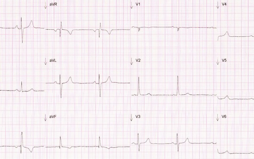 Dr Dave Richleys ECG of the Month – March 2022