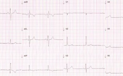 Dr Dave Richleys ECG of the Month – March 2022