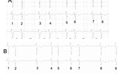 Dr Dave Richleys ECG of the Month – April 2022