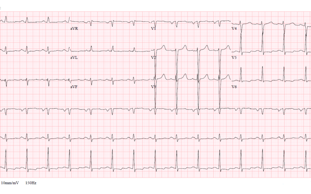 Dr Dave Richleys ECG of the Month – May 2022