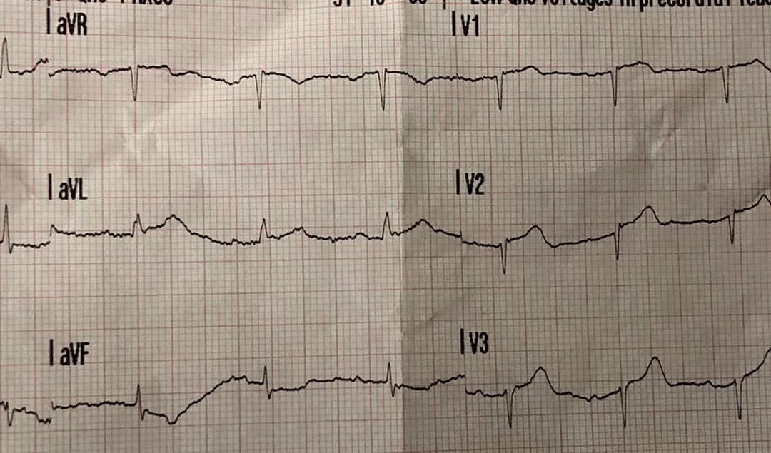 Dr Richleys ECG of the Month – June 2022