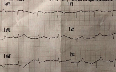 Dr Richleys ECG of the Month – June 2022