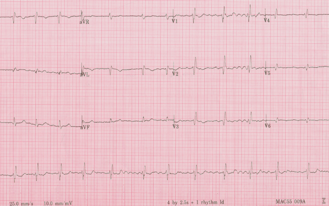 Dr Richleys ECG of the Month – August 2022