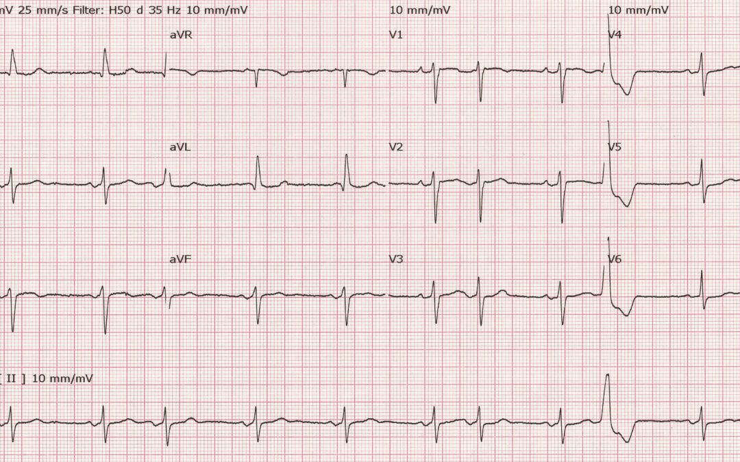 Dr Richleys ECG of the Month – December 2022
