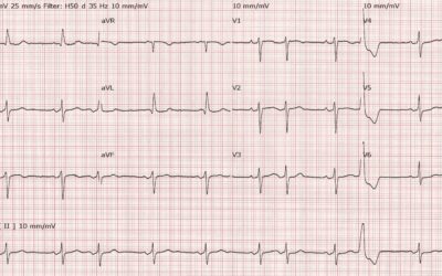 Dr Richleys ECG of the Month – December 2022