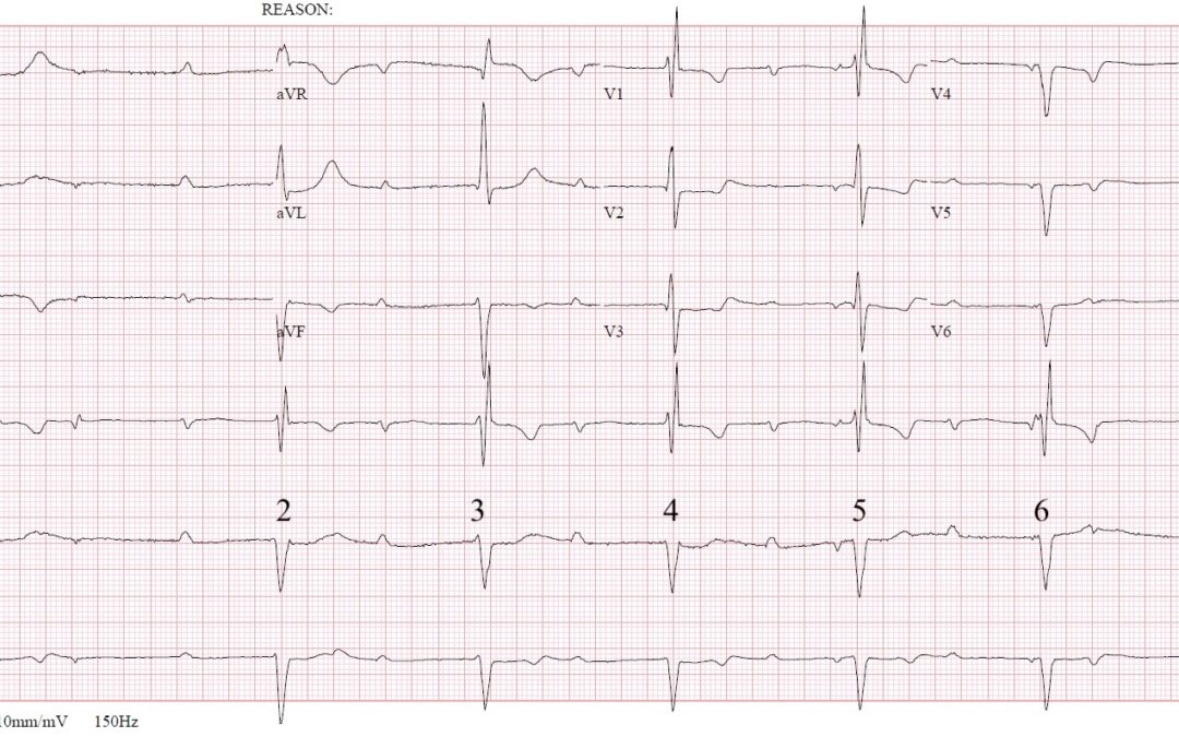 Dr Richleys ECG of the Month – February 2023
