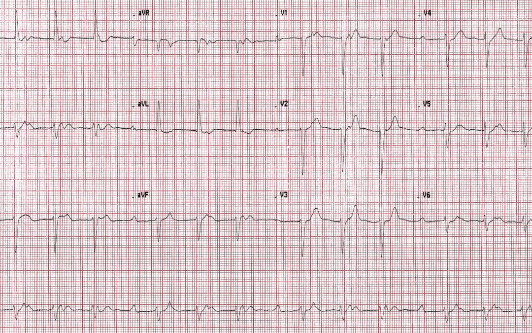 Dr Richleys ECG of the Month – January 2023